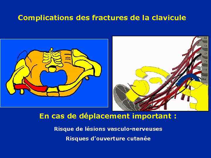 Complications des fractures de la clavicule En cas de déplacement important : Risque de