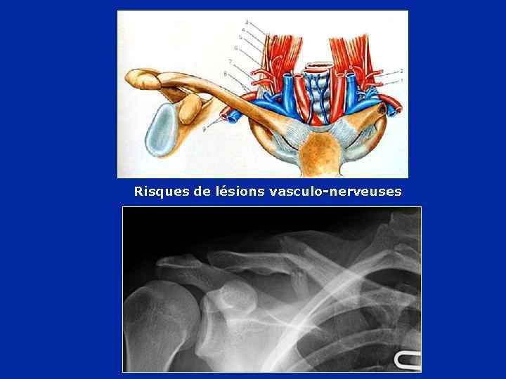 Risques de lésions vasculo-nerveuses 