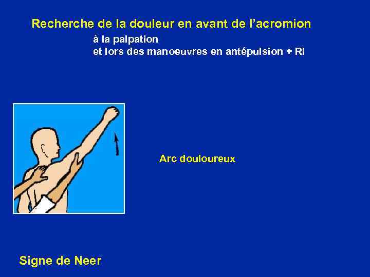 Recherche de la douleur en avant de l’acromion à la palpation et lors des