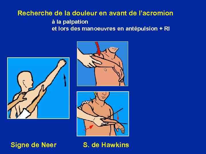 Recherche de la douleur en avant de l’acromion à la palpation et lors des