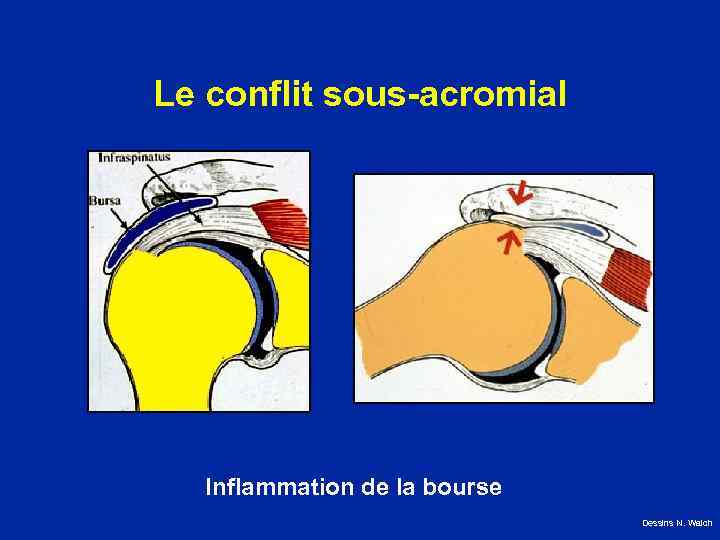 Le conflit sous-acromial Inflammation de la bourse Dessins N. Walch 