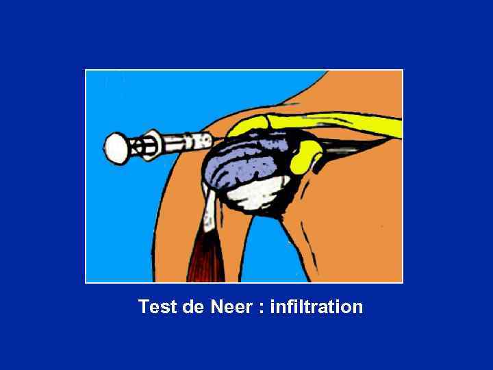 Test de Neer : infiltration 