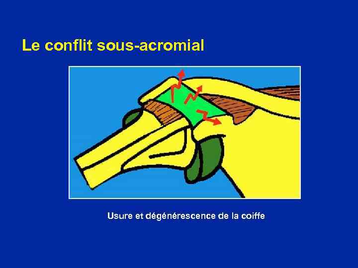 Le conflit sous-acromial Usure et dégénérescence de la coiffe 