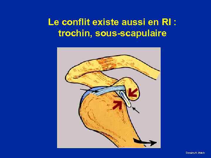 Le conflit existe aussi en RI : trochin, sous-scapulaire Dessins N. Walch 