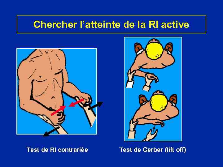 Chercher l’atteinte de la RI active Test de RI contrariée Test de Gerber (lift