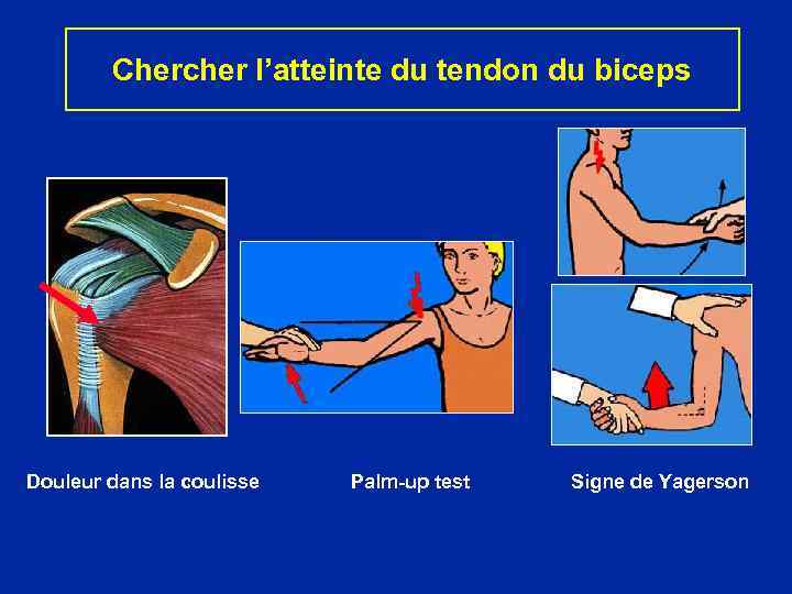 Chercher l’atteinte du tendon du biceps Douleur dans la coulisse Palm-up test Signe de