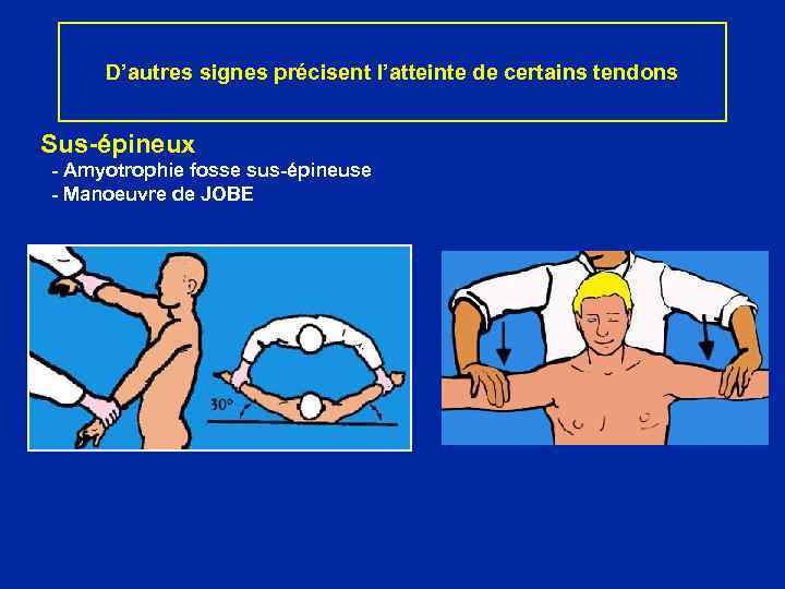 D’autres signes précisent l’atteinte de certains tendons Sus-épineux - Amyotrophie fosse sus-épineuse - Manoeuvre