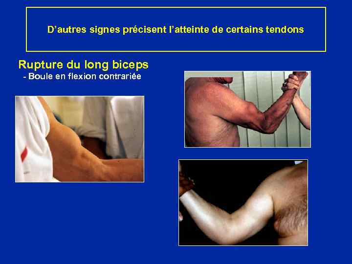 D’autres signes précisent l’atteinte de certains tendons Rupture du long biceps - Boule en