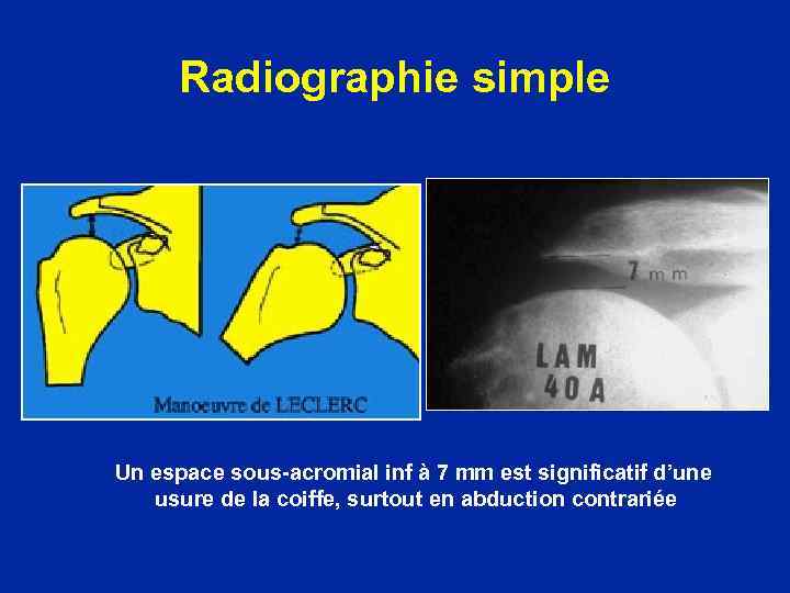 Radiographie simple Un espace sous-acromial inf à 7 mm est significatif d’une usure de