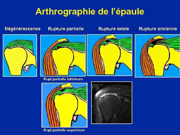 Arthrographie de l’épaule Dégénérescence Rupture partielle Rupt partielle inférieure Rupt partielle supérieure Rupture totale