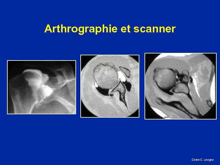 Arthrographie et scanner Cliché C. Lévigne 