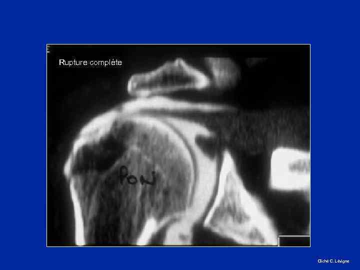 Rupture complète Cliché C. Lévigne 