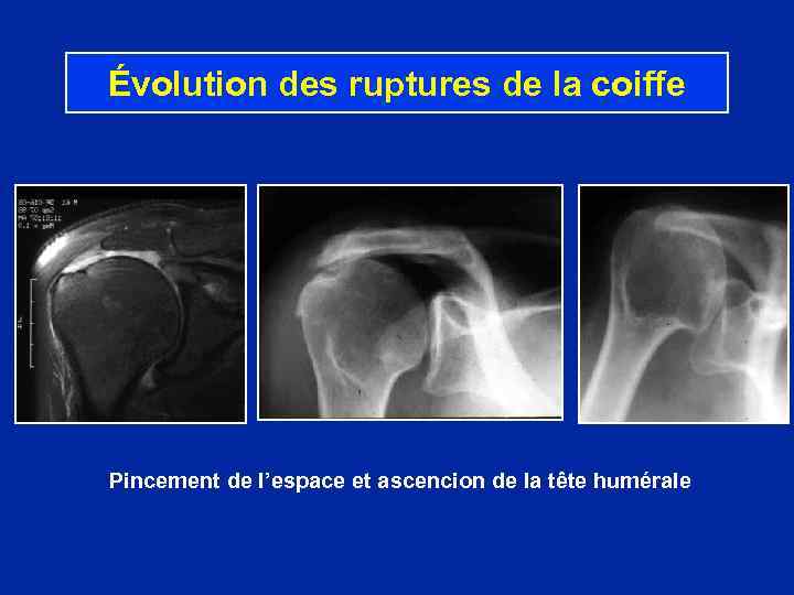 Évolution des ruptures de la coiffe Pincement de l’espace et ascencion de la tête