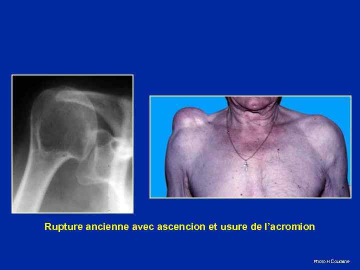 Rupture ancienne avec ascencion et usure de l’acromion Photo H Coudane 