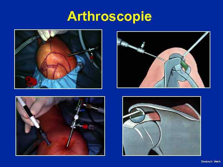 Arthroscopie Dessins N. Walch 