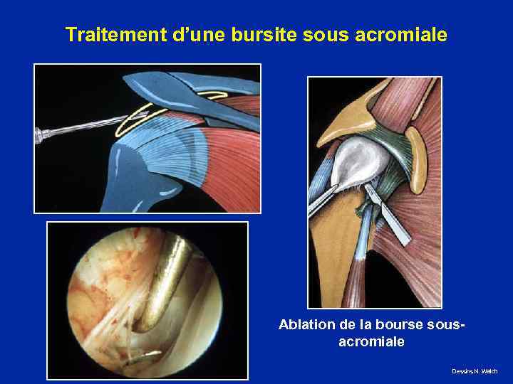 Traitement d’une bursite sous acromiale Ablation de la bourse sousacromiale Dessins N. Walch 