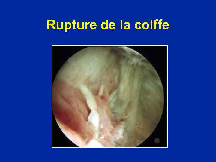 Rupture de la coiffe 