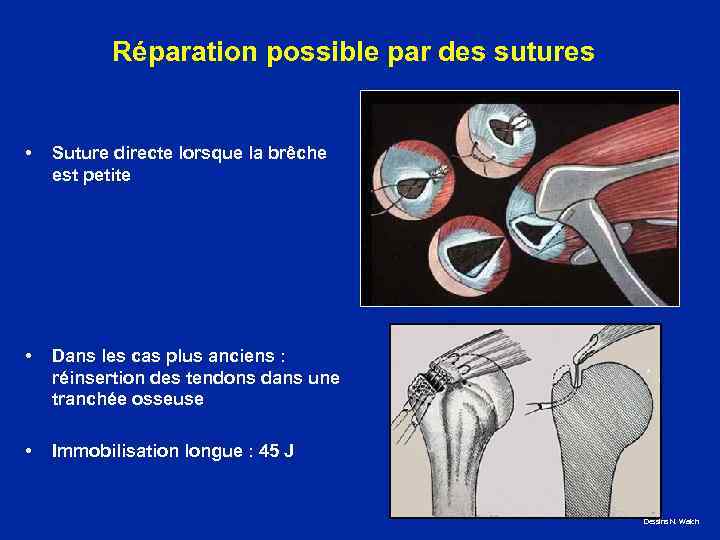 Réparation possible par des sutures • Suture directe lorsque la brêche est petite •