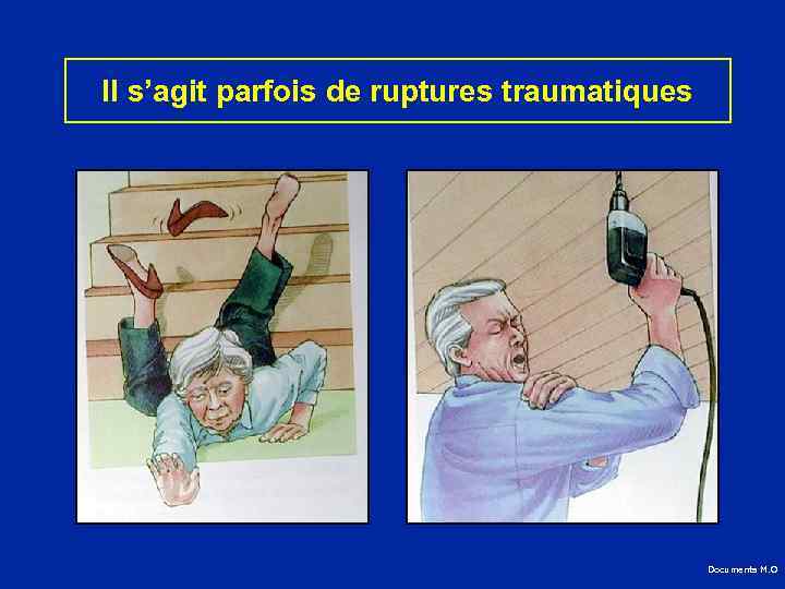 Il s’agit parfois de ruptures traumatiques Documents M. O 