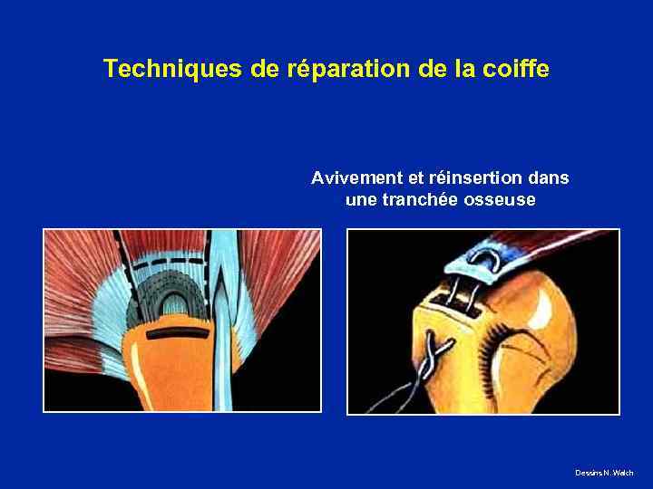 Techniques de réparation de la coiffe Avivement et réinsertion dans une tranchée osseuse Dessins