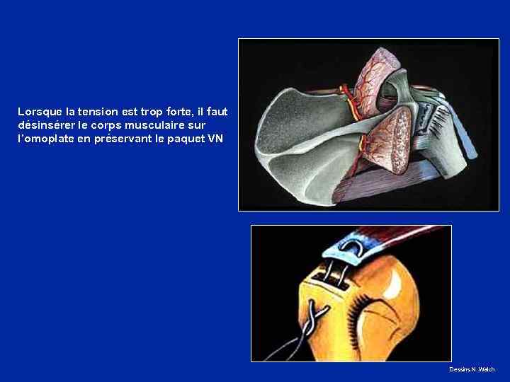 Lorsque la tension est trop forte, il faut désinsérer le corps musculaire sur l’omoplate