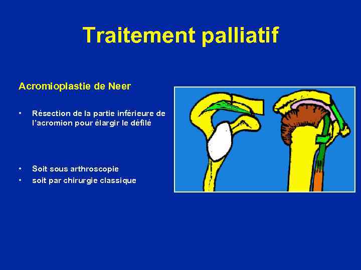 Traitement palliatif Acromioplastie de Neer • Résection de la partie inférieure de l’acromion pour
