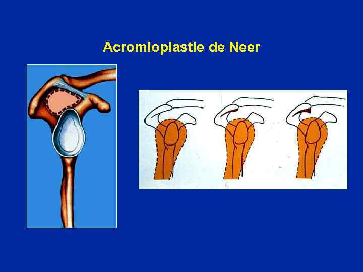 Acromioplastie de Neer 