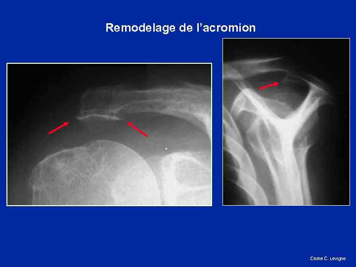 Remodelage de l’acromion Cliché C. Lévigne 