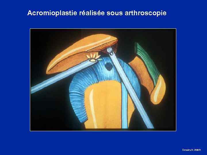 Acromioplastie réalisée sous arthroscopie Dessins N. Walch 