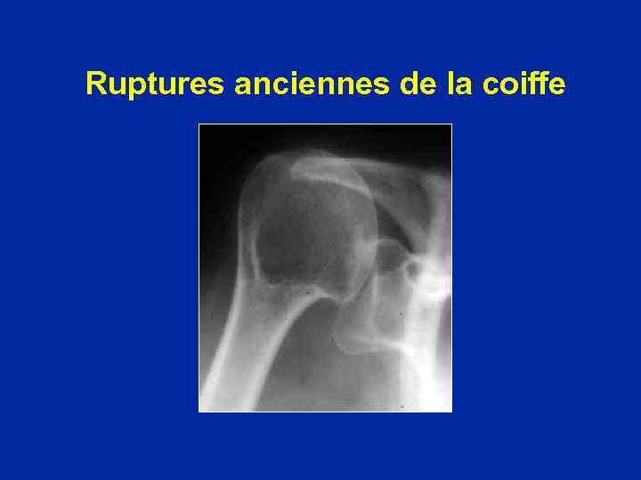 Ruptures anciennes de la coiffe 