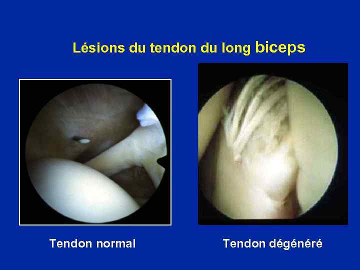 Lésions du tendon du long biceps Tendon normal Tendon dégénéré 