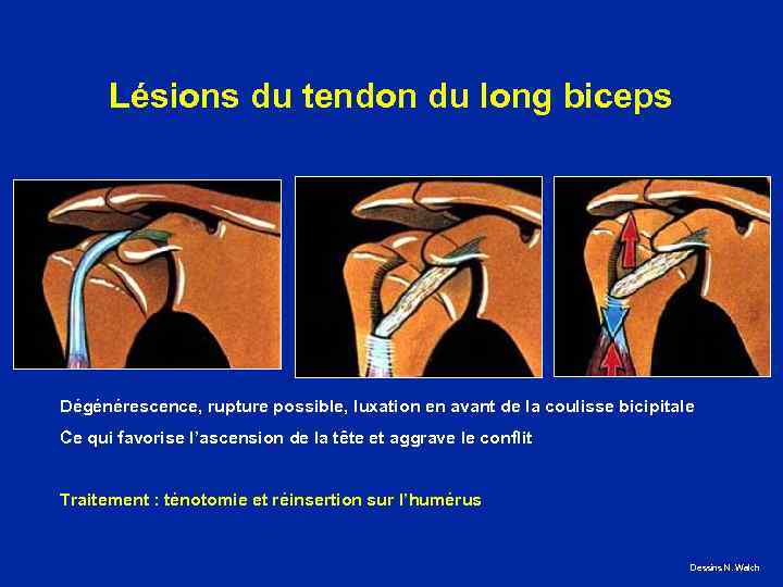 Lésions du tendon du long biceps Dégénérescence, rupture possible, luxation en avant de la