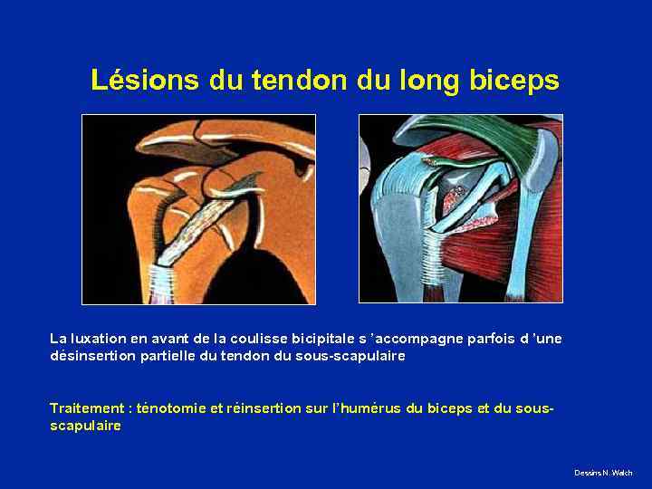 Lésions du tendon du long biceps La luxation en avant de la coulisse bicipitale