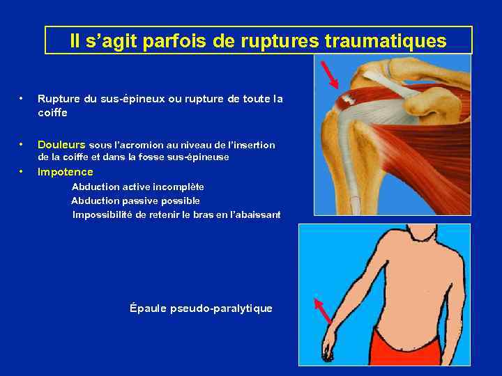 Il s’agit parfois de ruptures traumatiques • Rupture du sus-épineux ou rupture de toute