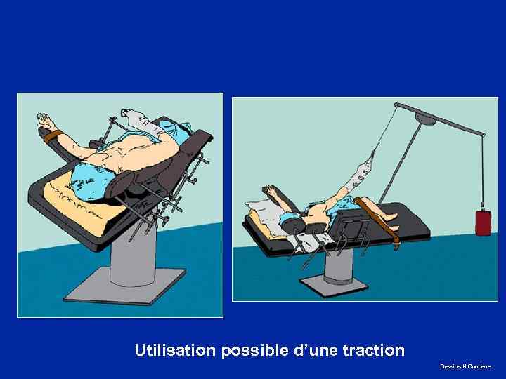 Utilisation possible d’une traction Dessins H Coudane 