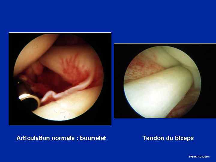 Articulation normale : bourrelet Tendon du biceps Photos H Coudane 