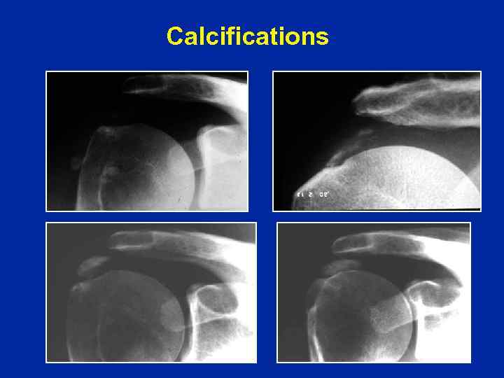 Calcifications 