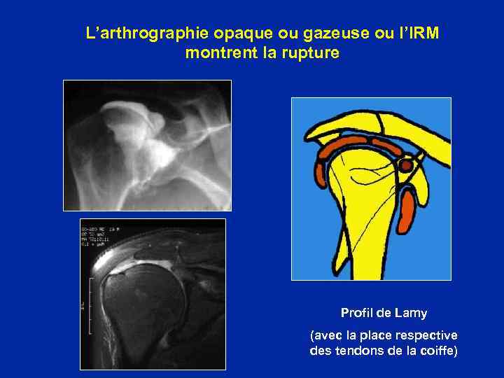 L’arthrographie opaque ou gazeuse ou l’IRM montrent la rupture Profil de Lamy (avec la