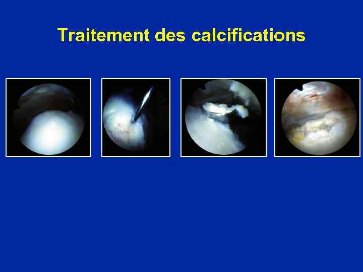 Traitement des calcifications 