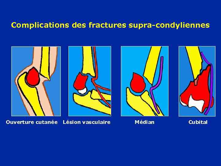 Complications des fractures supra-condyliennes Ouverture cutanée Lésion vasculaire Médian Cubital 
