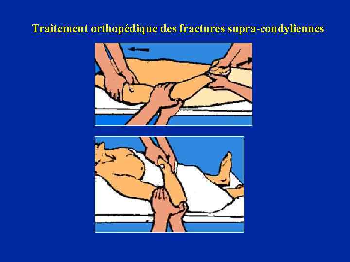 Traitement orthopédique des fractures supra-condyliennes 