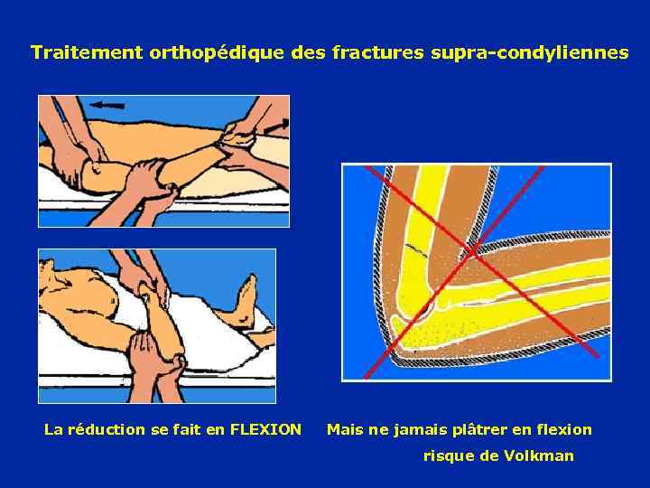 Traitement orthopédique des fractures supra-condyliennes La réduction se fait en FLEXION Mais ne jamais