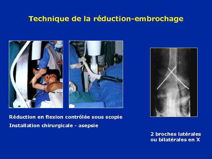 Technique de la réduction-embrochage Réduction en flexion contrôlée sous scopie Installation chirurgicale - asepsie