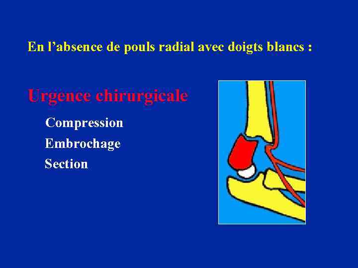 En l’absence de pouls radial avec doigts blancs : Urgence chirurgicale Compression Embrochage Section