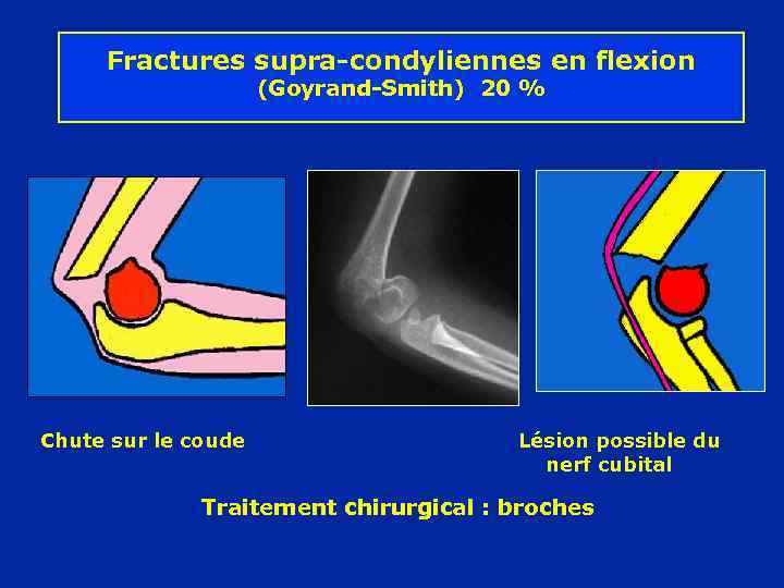 Fractures supra-condyliennes en flexion (Goyrand-Smith) 20 % Chute sur le coude Lésion possible du