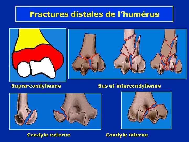 Fractures distales de l’humérus Supra-condylienne Condyle externe Sus et intercondylienne Condyle interne 