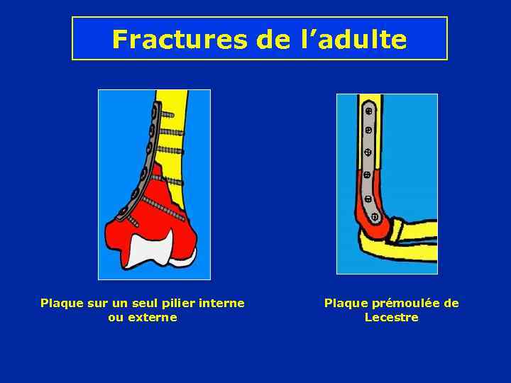 Fractures de l’adulte Plaque sur un seul pilier interne ou externe Plaque prémoulée de