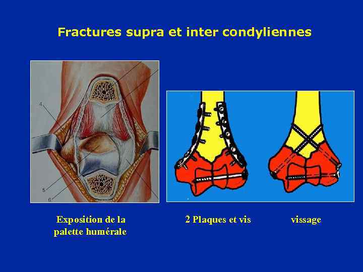 Fractures supra et inter condyliennes Exposition de la palette humérale 2 Plaques et vissage