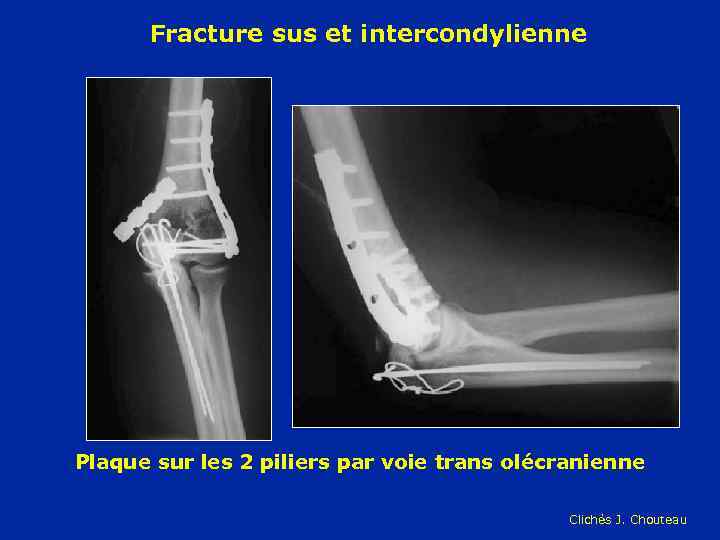 Fracture sus et intercondylienne Plaque sur les 2 piliers par voie trans olécranienne Clichés