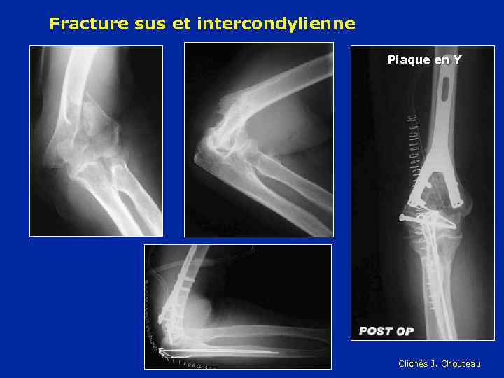 Fracture sus et intercondylienne Plaque en Y Clichés J. Chouteau 